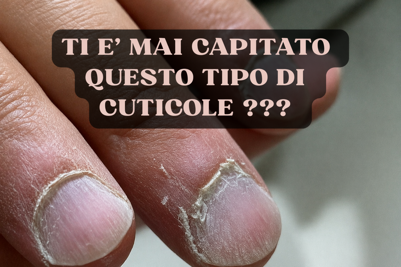 Ti è mai capitato questo tipo di cuticole?